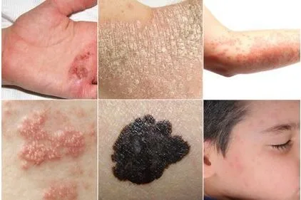 Ziua internaţională a luptei împotriva maladiei Lupus