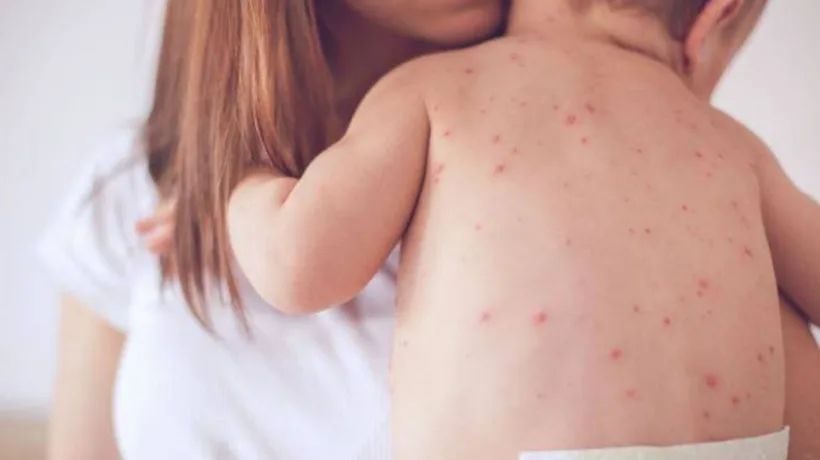 Avocatul Poporului avertizează: În România e epidemie de rujeolă