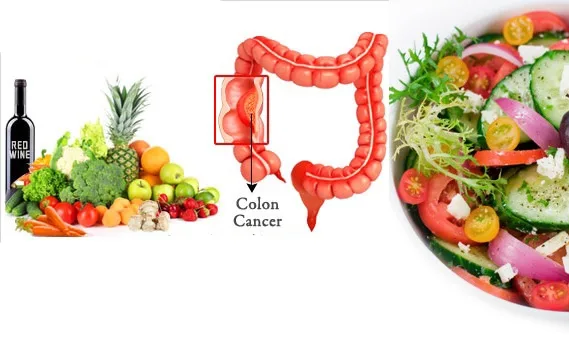 Cancerul de colon, ameliorat printr-o alimentație bazată pe legume