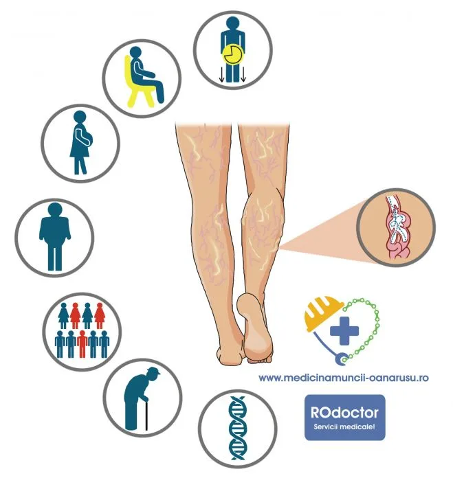 Bolile Venoase Cronice, punct de plecare într-o amplă dezbatere științifică a specialiștilor din sistemul medical