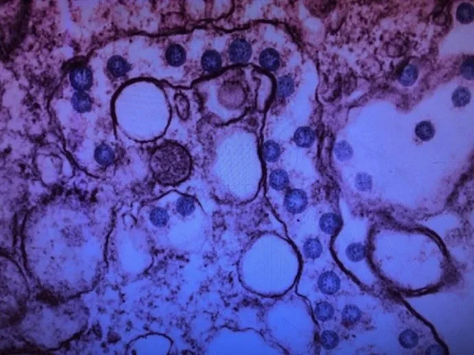 Coronavirus si infectia COVID-19